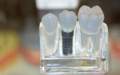 LA Dental Arts-Bershadsky DDS-Los Angeles Dentist-dental implants picture