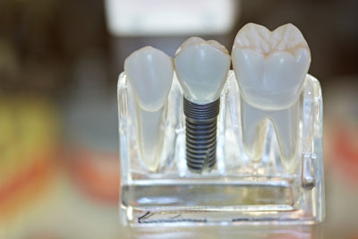 LA Dental Arts-Bershadsky DDS-Los Angeles Dentist-dental implants picture