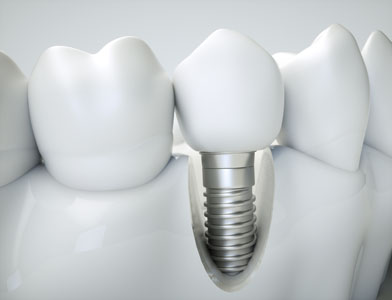 LA Dental Arts-Bershadsky DDS-Los Angeles Dentist-dental implant services