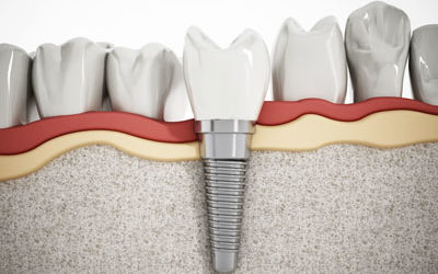 LA Dental Arts-Bershadsky DDS-Los Angeles Dentist-dental-implants20174