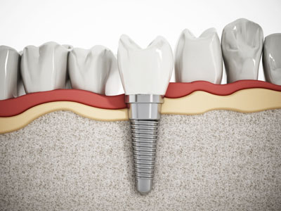 LA Dental Arts-Bershadsky DDS-Los Angeles Dentist-dental-implants20174