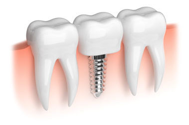 LA Dental Arts-Bershadsky DDS-Los Angeles Dentist-dental-implants20175