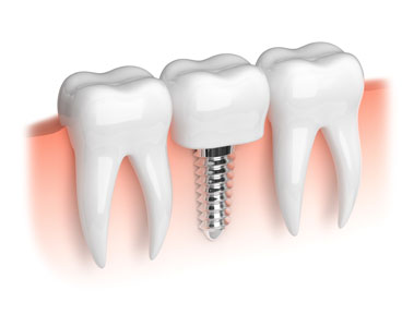 LA Dental Arts-Bershadsky DDS-Los Angeles Dentist-dental-implants20175