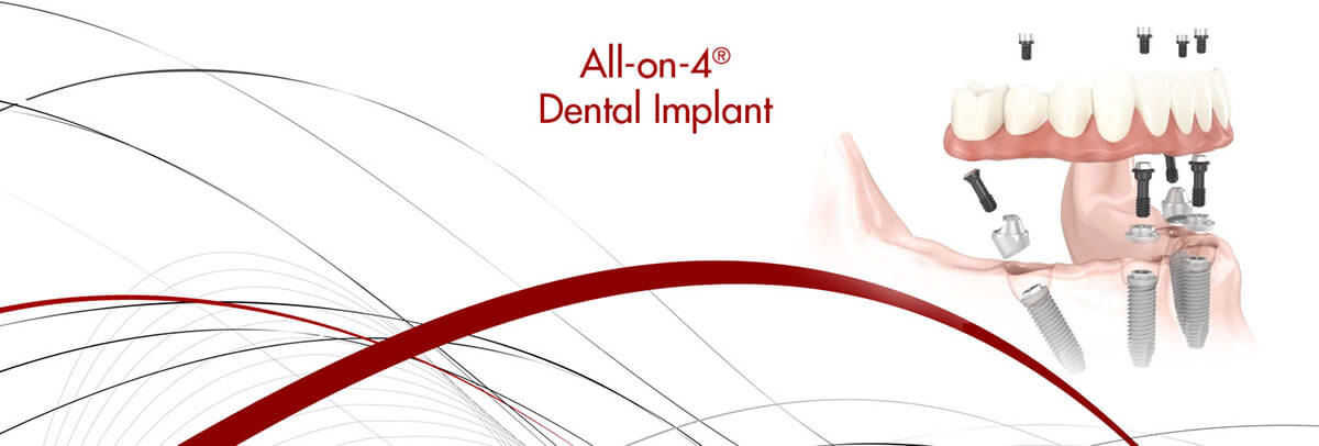 all-on-4-dental-implants-header