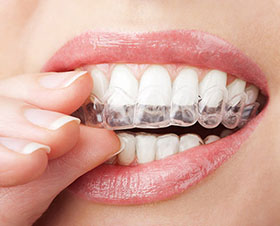 LA Dental Arts-Bershadsky DDS-Los Angeles Dentist-alternative to braces for teens