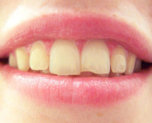 LA Dental Arts-Bershadsky DDS-Los Angeles Dentist-chip my tooth