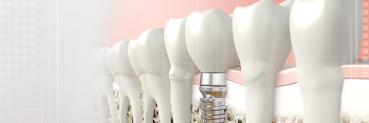 LA Dental Arts - Bershadsky DDS - Los Angeles Dentist - Composite Fillings Header