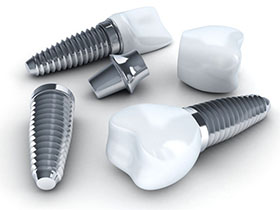 LA Dental Arts-Bershadsky DDS-Los Angeles Dentist-dental implant candidate