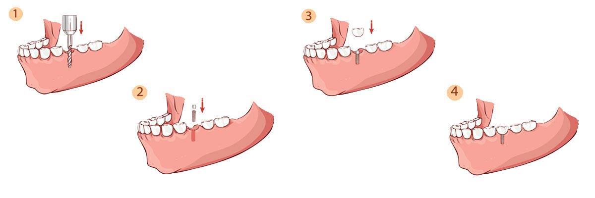 LA Dental Arts-Bershadsky DDS-Los Angeles Dentist-dental implant procedure header