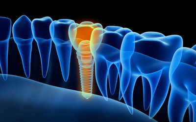 LA Dental Arts-Bershadsky DDS-Los Angeles Dentist-dental-implants20176