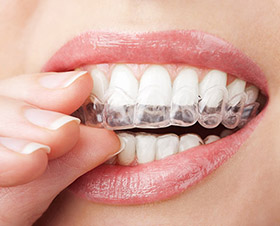 LA Dental Arts-Bershadsky DDS-Los Angeles Dentist-does invisalign really work