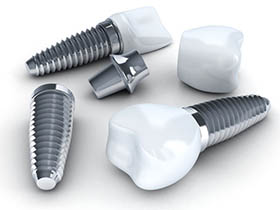 LA Dental Arts-Bershadsky DDS-Los Angeles Dentist-implants vs mini implants