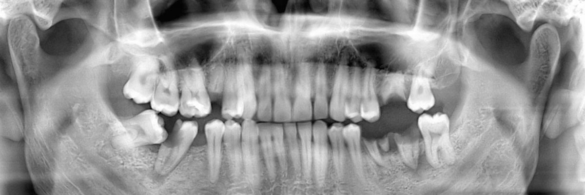 LA Dental Arts-Bershadsky DDS-Los Angeles Dentist-options for replacing missing teeth header
