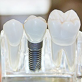 LA Dental Arts-Bershadsky DDS-Los Angeles Dentist-prosthodontist