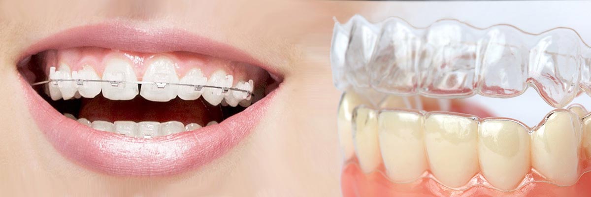 LA Dental Arts-Bershadsky DDS-Los Angeles Dentist-which is better invisalign or braces